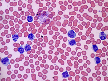 Lymphocytosis.jpg